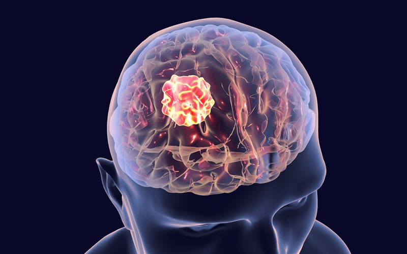 علت تومور مغزی چیست